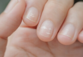 نقص البروتين: الأعراض والأسباب والعلاجات